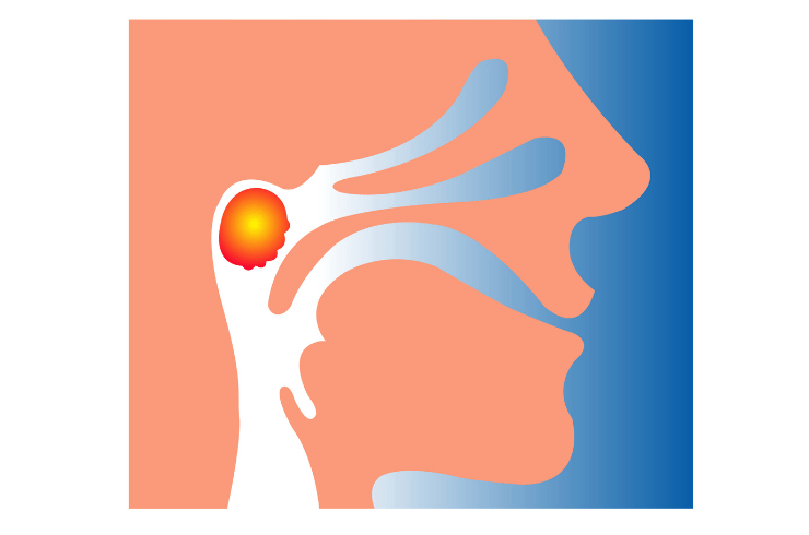 adenoids